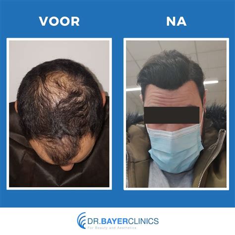 De Effecten Van Haartransplantatie Voor En Na De Procedure