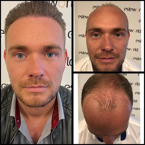 Ethische Overwegingen Bij Haartransplantatie