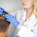 De Impact Van Stress Op Haarverlies En Haartransplantatie