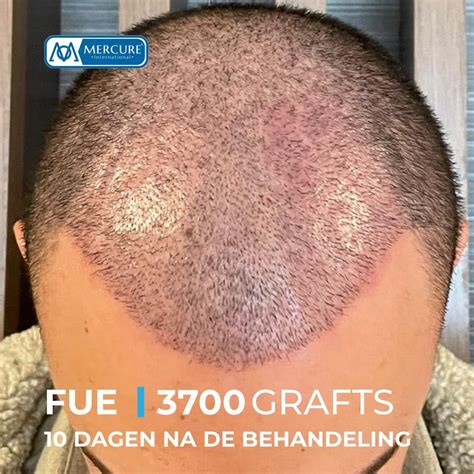 Haartransplantatie Saffier FUE: Wat Maakt Het Uniek?