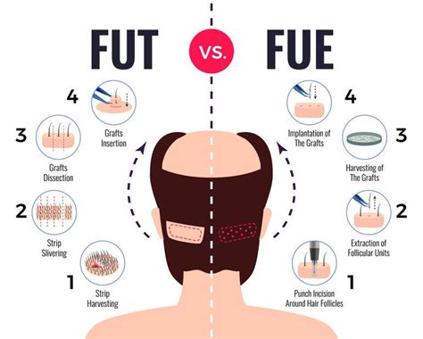 Haartransplantatie Technieken: Wat Zijn De Verschillen?