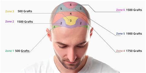 Haartransplantatie Kosten In Vergelijking Met Andere Methodes