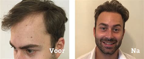 Langdurige Resultaten Van Haartransplantatie