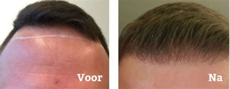 Haartransplantatie En Haaruitval: Wat Is De Verbinding?