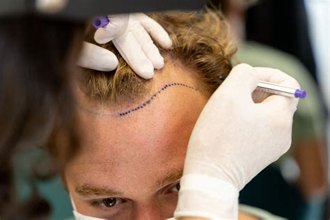 Haartransplantatie Kliniek Beoordelingen: Hoe Kies Je?