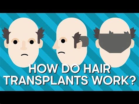 Hoe Werkt Een Haartransplantatie?