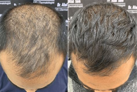 De Impact Van Leeftijd Op Haartransplantatie Resultaten