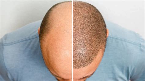 Haartransplantatie En Onderhoud: Hoe Houd Je Je Haardos Gezond?
