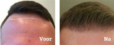 Haartransplantatie Spoed: Wanneer Is Het Nodig?