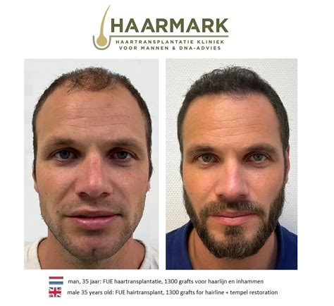 Haartransplantatie Trends Voor 2023